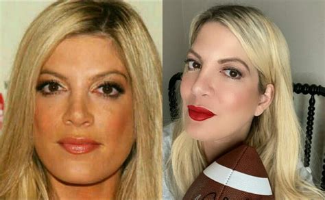 Before And After Pics Of Hollywood Celebrities Having Plastic Surgery Gluwee