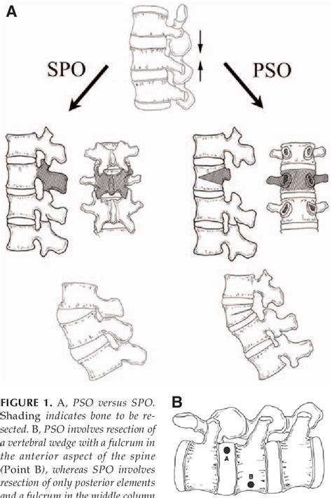 Figure 1 From Lumbar Pedicle Subtraction Osteotomy Semantic Scholar