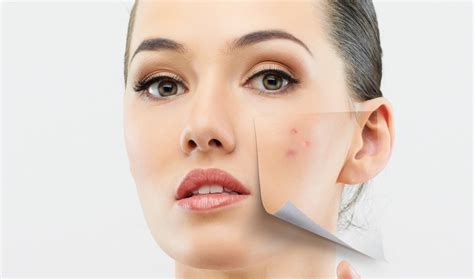 It is specifically for preventing keloid and hypertrophic. Lebih Bagus Mederma Atau Dermatix - Info Kesehatan