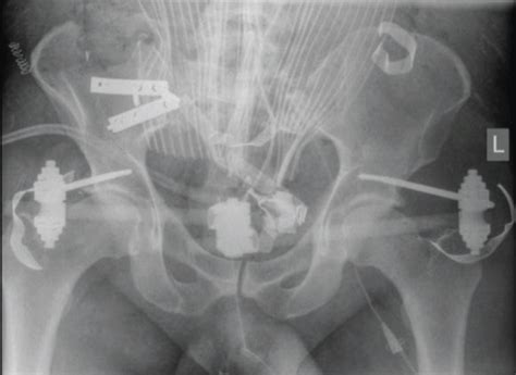 A Rare Case Of Complex Pelvic Injury And Associated Intrathecal Fat