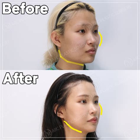 Facial Contouring Des Revision Before And After