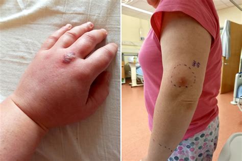 Glasgow Bus Driver Hospitalised After Tiny Itch On Hand Turns Out To Be