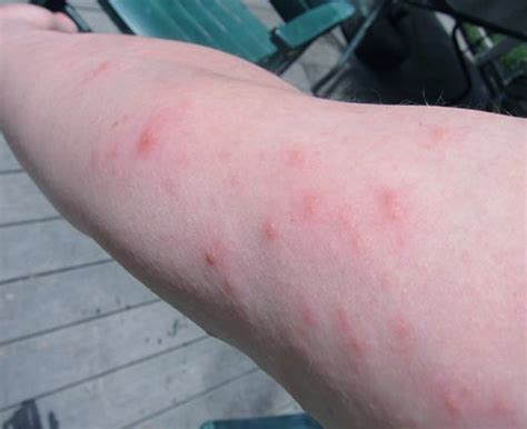 Pictures Of Poison Ivy Rash On Body