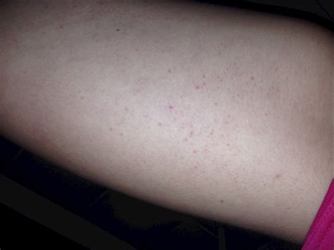 Red And Purple Bumps On Legs Especially Inner Thi My Skin