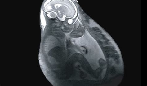 resonancia fetal unidad de resonancia magnética universidad nacional autónoma de méxico