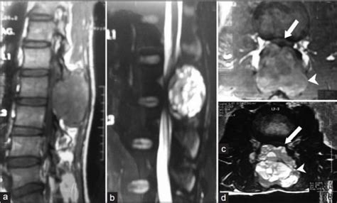 Mri Spine Showing Well Defined Expansile Mass Lesion Arrow Head At L2