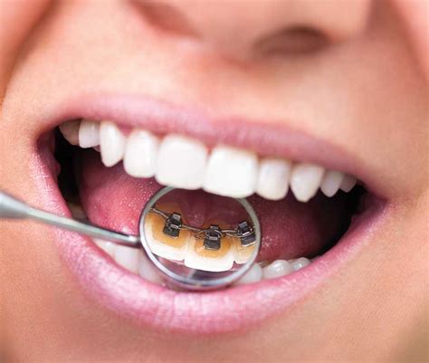 For poking wire, please try to see with a mirror and good lighting which part is poking then try to push the poking wire using eraser tip of a pencil or small q tips. Lingual Braces - An Invisible Way to Straighten Teeth