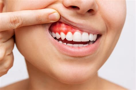 Paradontoza Przyczyny Objawy I Sposoby Leczenia Frankowski Dental