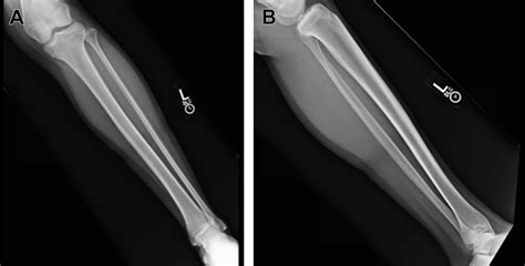Tibial Stress Fractures In Athletes Orthopedic Clinics