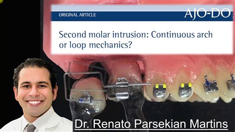 Second Molar Intrusion Continuous Arch Or Loop Mechanics Youtube