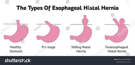 Hiatal Hiatal Hernia And Normal Anatomy Of The Stomach Stock Vector By