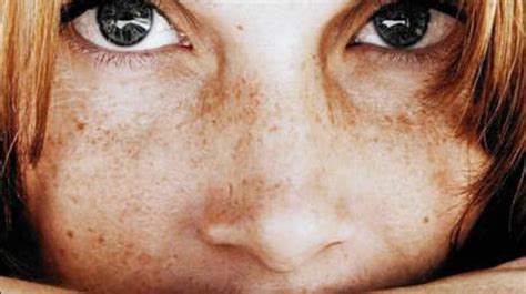 Freckle Gene Might Add 2 Years To The Face Chicago Tribune