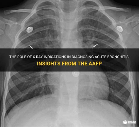 The Role Of X Ray Indications In Diagnosing Acute Bronchitis Insights