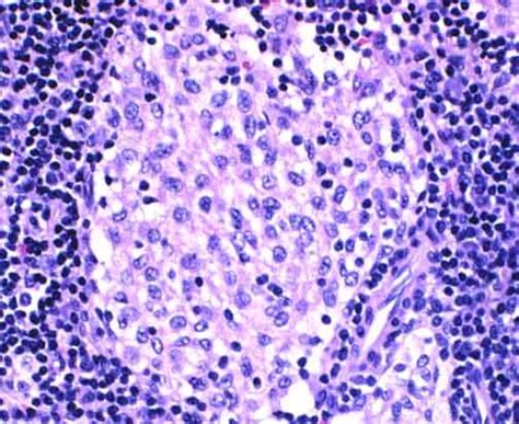 Sinus Histiocytosis Fluffy Cytoplasm And Poorly Defined Cell Borders