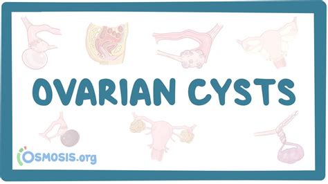 Can Cyst On Your Ovaries Prevent Pregnancy Pregnancywalls