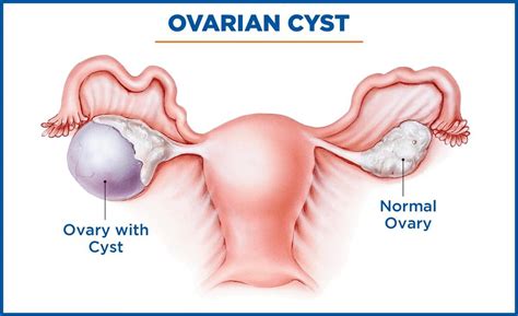 Ovarian Cyst Surgery Ovarian Cyst Treatment In Thane Mumbai India