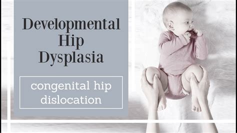 Developmental Hip Dysplasia Congenital Hip Dislocation Youtube