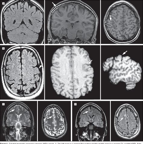Figure 1 From Identifying Subtle Cortical Gyral Abnormalities As A