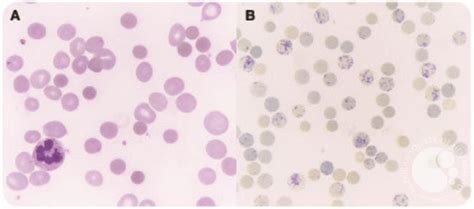 A Rare Case Of Autoimmune Hemolytic Anemia