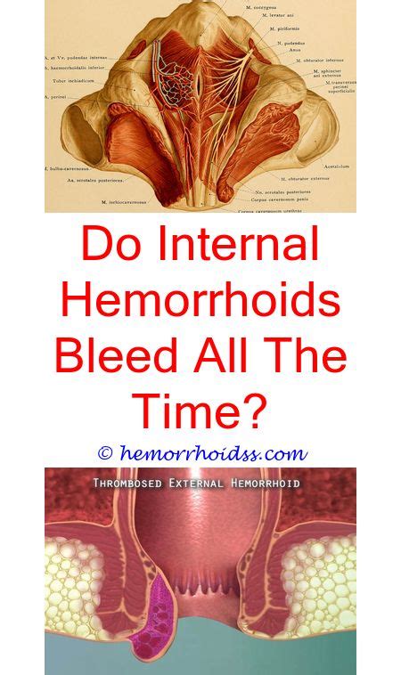 How Much Is Hemorrhoid Surgery Hemorrhoids Treatment Bleeding