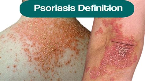 Psoriasis Definition What Is Plaque Psoriasis Shampoo For Scalp