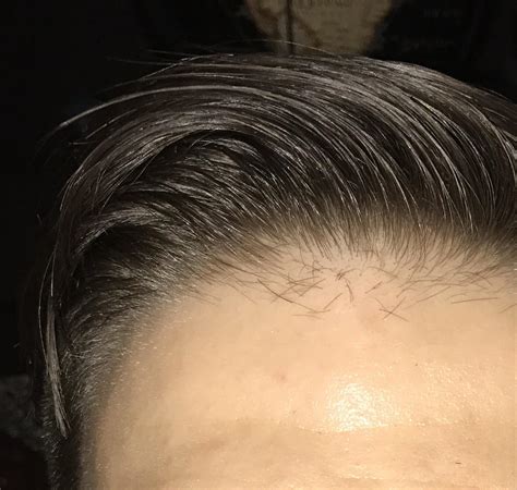 How To Grow Baby Hairs On Forehead Get More Anythinks