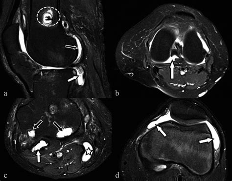 Knee Recesses The Sagittal A Fat Saturated Proton Density Weighted Download Scientific