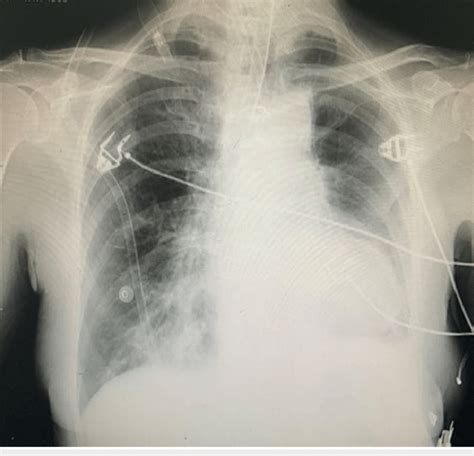 Post Intubation Chest X Ray Sexiz Pix