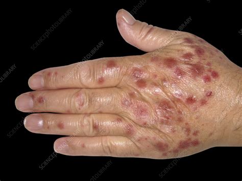 Erythema Multiforme On A Womans Hand Stock Image C0584167