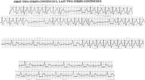 Intermittent High Grade Atrioventricular Block In A Man With Infective