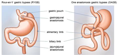 Illustration Of The Two Gastric Bypass Techniques Roux En Y And One Download Scientific