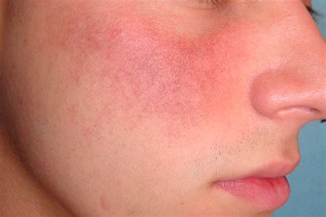 Women With Rosacea Twice As Likely To Have Celiac Disease And Other