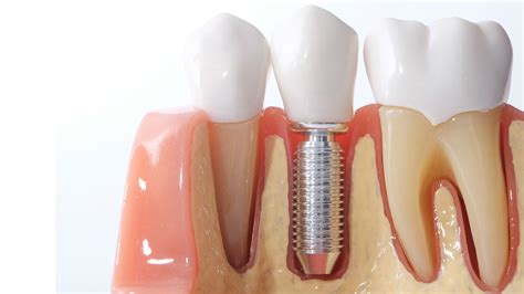 How to get a free dental implant. Colgate Oral Health Network - Free Dental Continuing Education