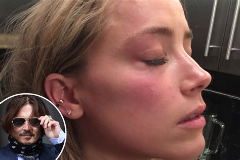 Shocking New Picture Shows Amber Heard With Bruises After Johnny Depp ‘hurled Phone At Her In