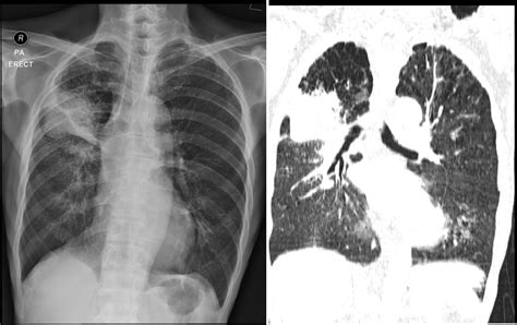 Non Small Cell Lung Cancer Adenocarcinoma Radiology Cases