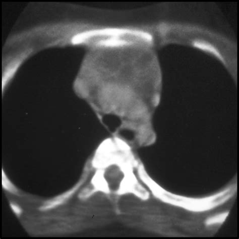 Thymic Cyst Pediatric Radiology Reference Article Pediatric Imaging