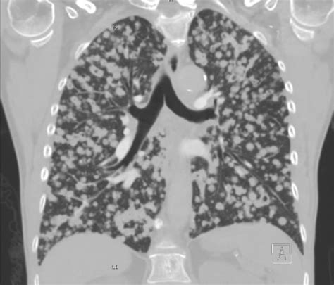 Primary Lung Adenocarcinoma Presenting As Innumerable Pulmonary Nodules