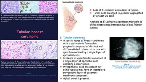 Pathophysiology Of Breast Cancer