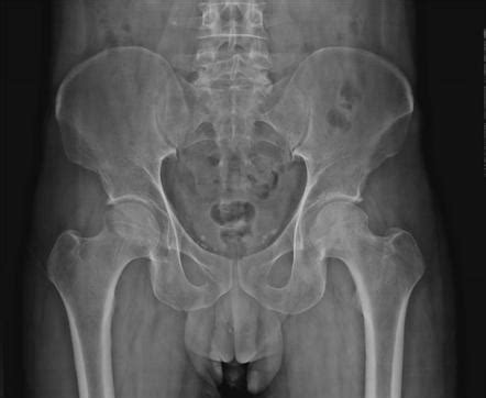 Avascular Necrosis Of The Hip Radiology Case Radiopaedia Org