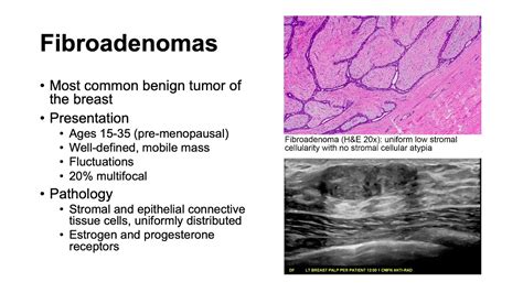 Fibroadenomas And Phyllodes Tumors Youtube