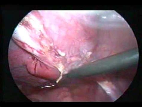 Download female back images and photos. Laparoscopy in intersex disorder, Bangladesh.mpg - YouTube