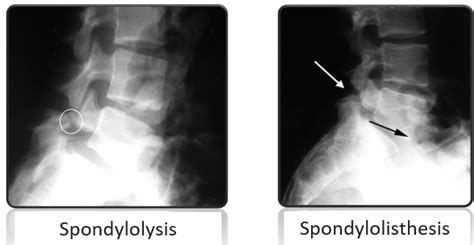 Spondylolysis And Spondylolisthesis Backpro Integrated Health Clinic En