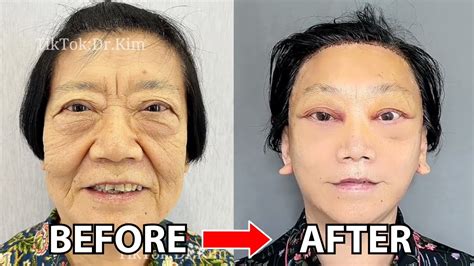 Plastic Surgeon Dr Kims Viral Face Lifts Youtube