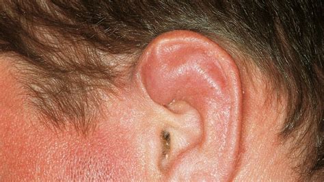 Lump On Ear What To Do Ent Specialist Singapore