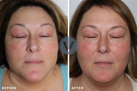 Saving Face Facial Vein Treatment Options The Vein Institute