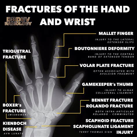 Different Types Of Wrist Fractures The Bone Joint Cen