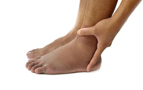 Swelling Ankles Stock Photos Pictures And Royalty Free Images Istock