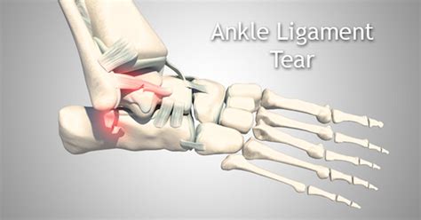 Ankle Ligament Tear Stock Video Envato Elements