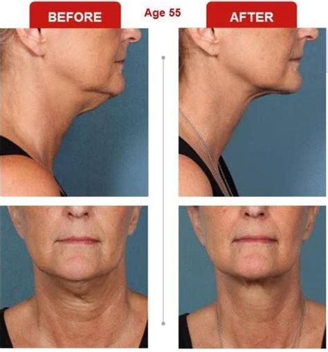 Can Botox Get Rid Of Double Chin Trent Leithiser