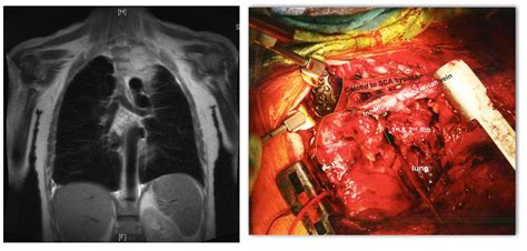 Scvs En Bloc Resection Of Pancoast Tumor With Adjuvant Aortic